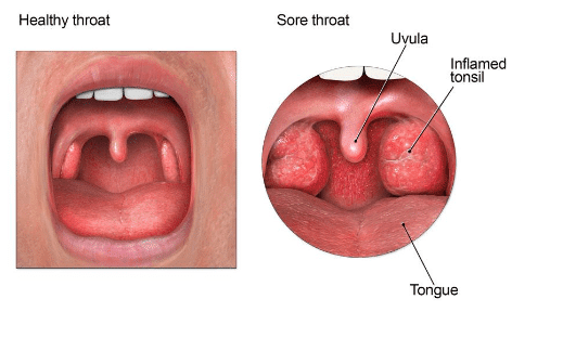 throat gonorrhea symptoms